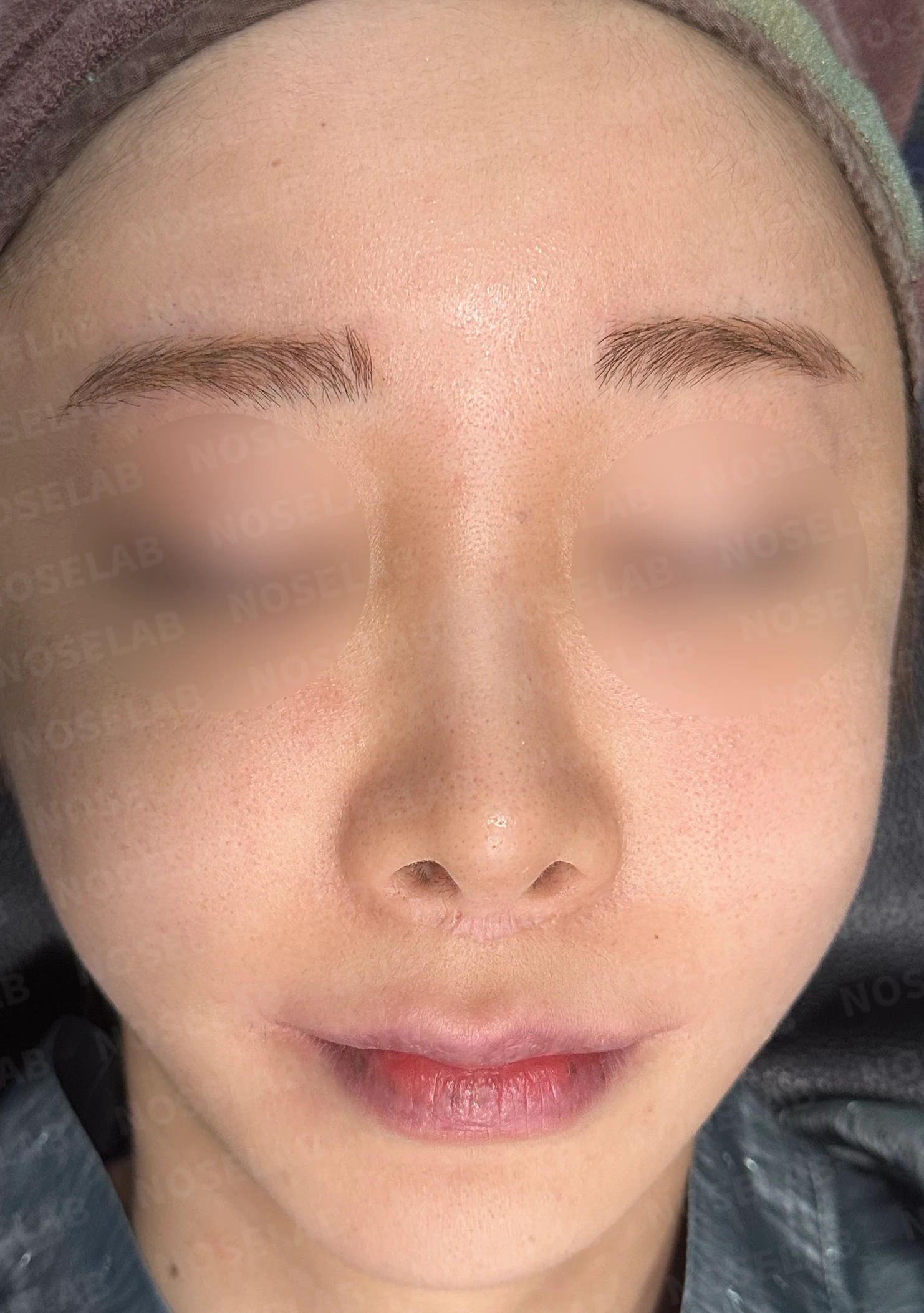 짧고 들린 코교정 방법 — 수술 전 / 수술 직후 0일 직후 사진은 부기가 있는 상태로 최종 결과와 다를 수 있습니다.