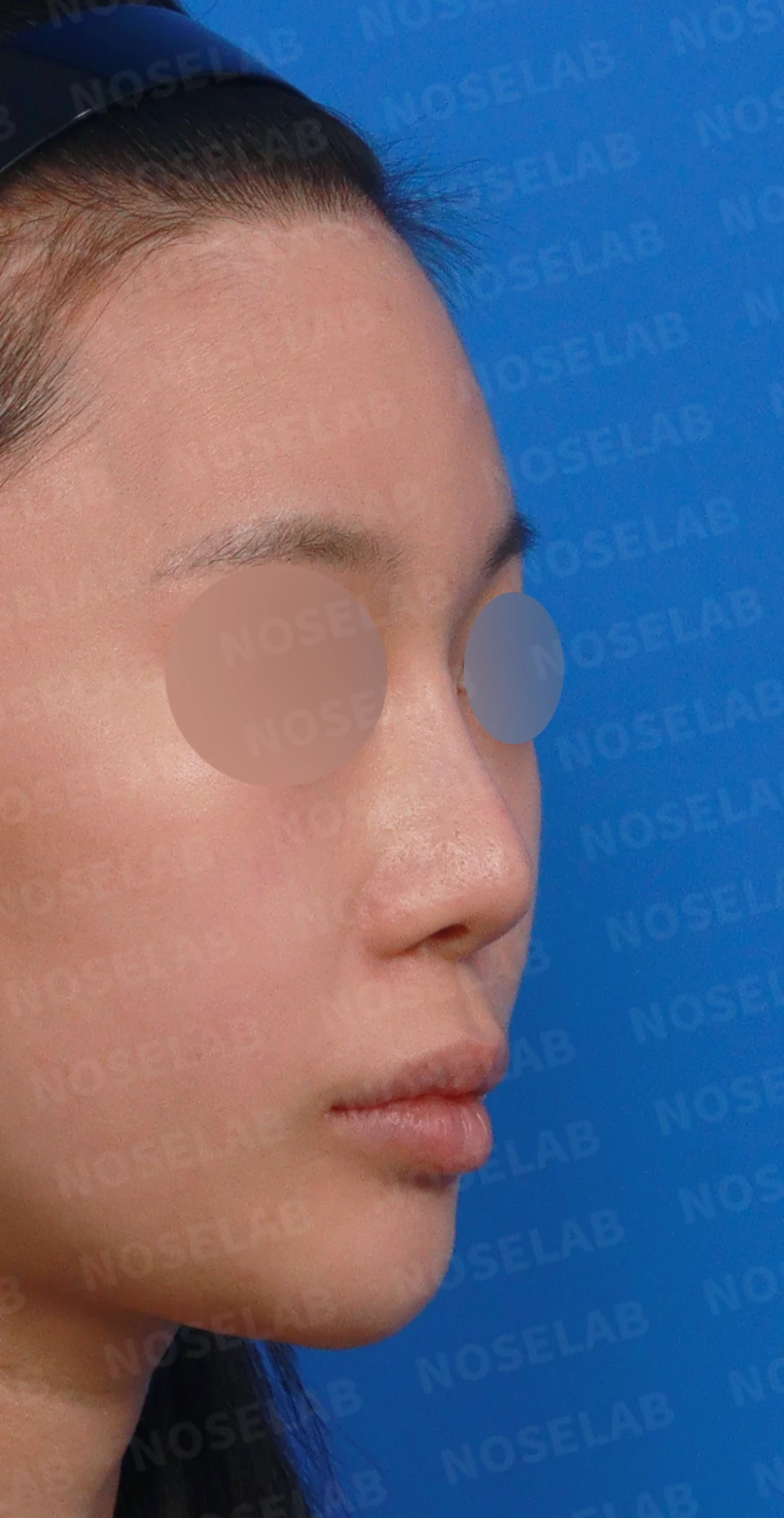 비중격 천공이 생기면 무엇이 문제이고 어떻게 재건하나 — 디자인 상담 우측 측면, 비스듬한 측면, 비공 사진입니다.