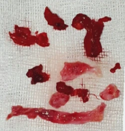 만성 이물 반응과 긴 코의 이물질 제거 및 자가늑연골 재수술 방법 — 제거된 이물질(위), 육아조직(중간), 보형물 피막(아럐)사진입니다.
