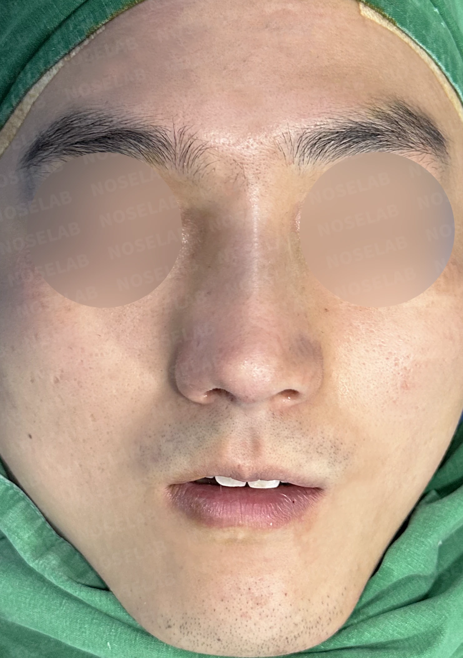 비중격이 휘면 코막힘과 휜 코가 함께 생기는 이유, 재건은 어떻게 하나 — 수술 전 / 수술 직후 0일 직후 사진은 부기가 있는 상태로 최종 결과와 다를 수 있습니다.