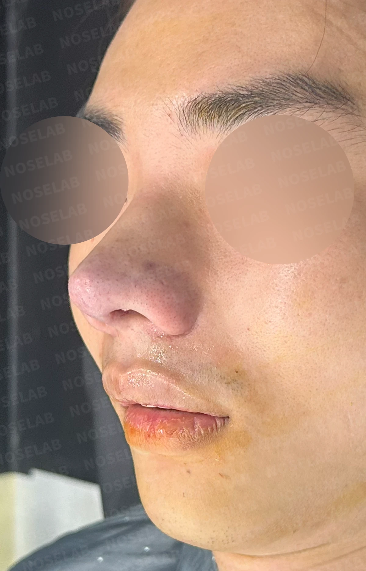 코뼈 골절에 미용 수술을 함께 할 수 있는 경우와 단계로 나누는 방법 — 수술 직후 0일 정면, 측면, 비스듬한 측면 사진 직후 사진은 부기가 있는 상태로 최종 결과와 다를 수 있습니다.