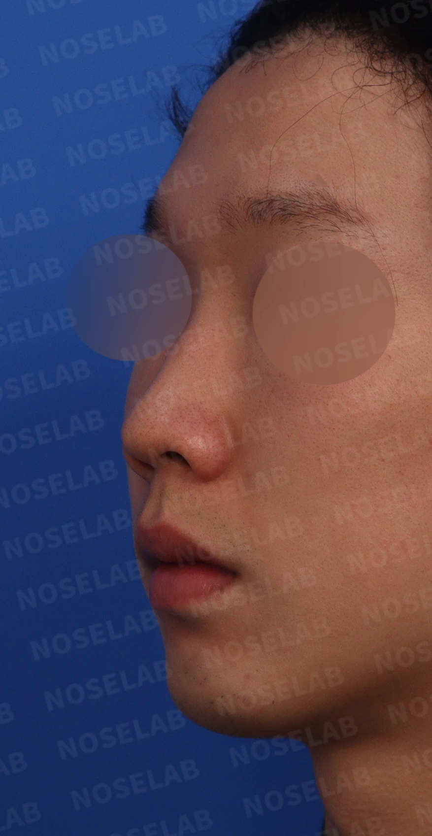 들린코, 작은코, 비순각 교정 사례 - 기능과 미용을 동시에 잡다 — 수술전 디자인 상담 정면, 좌측 비스듬한 측면, 측면 사진입니다.