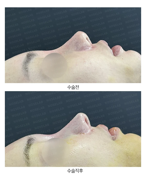 복코·휜코·들린코 교정 방법 — 전후 비교