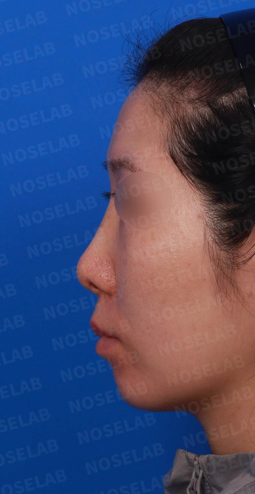 콧대 시작점이 높고 코가 휘어 보이는 이유, 자가 늑연골 교정은 어떻게 하나 — 디자인 상담 정면 , 비스듬한 측면 , 측면 사진입니다