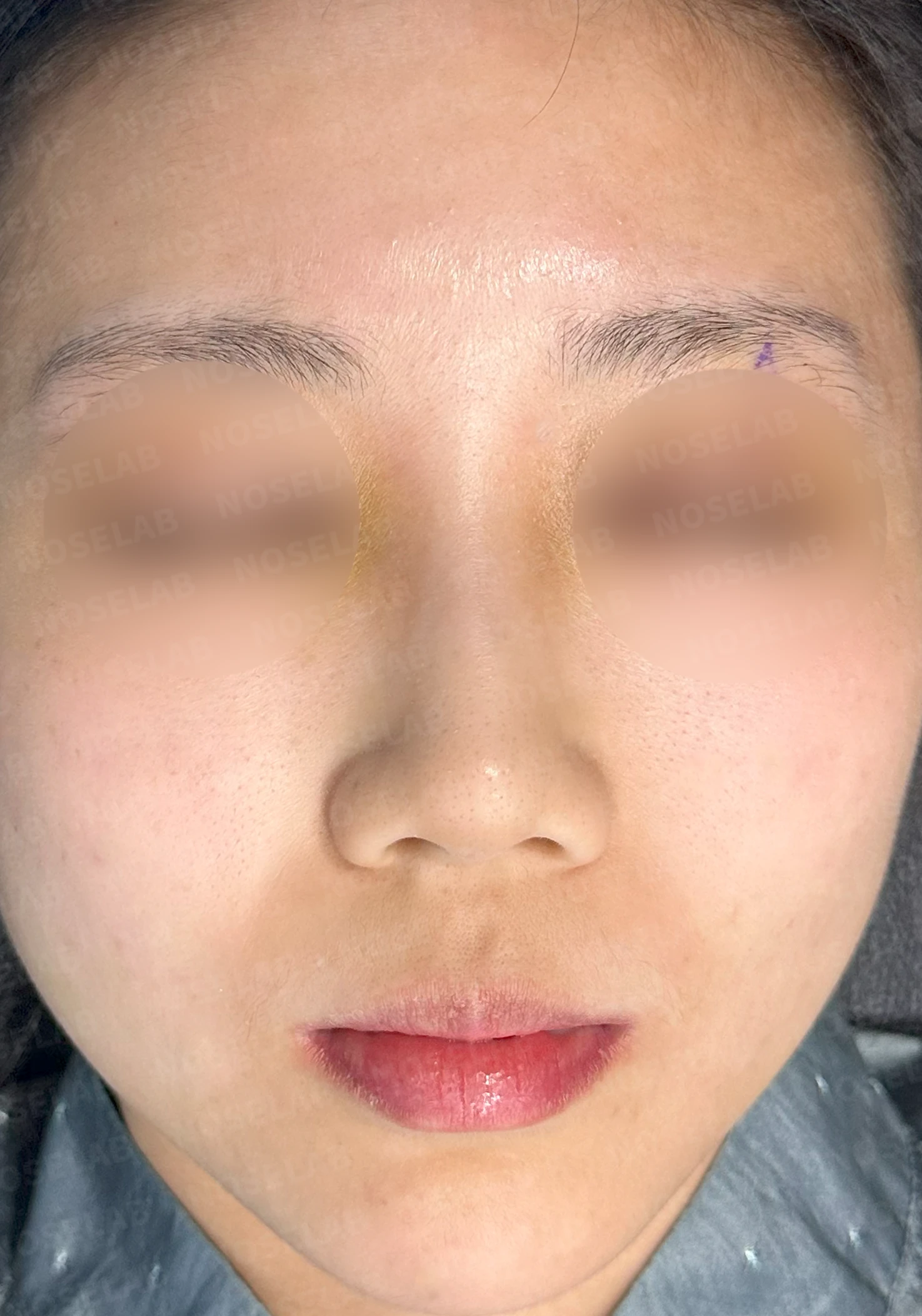 작은 코와 비공 비대칭을 함께 살펴보는 교정 방법 — 수술 전 / 수술 직후 0일 직후 사진은 부기가 있는 상태로 최종 결과와 다를 수 있습니다.