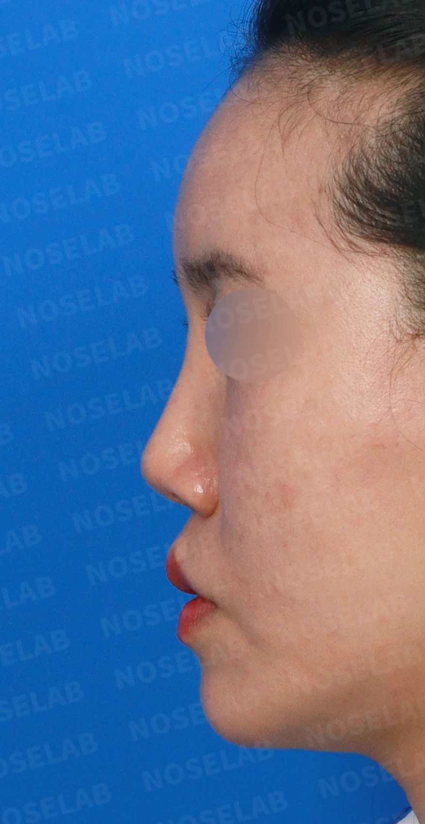 메드포어를 넣은 코에 코막힘이 생기는 이유, 제거와 자가늑연골 비중격 재건은 어떻게 하나 — 디자인 상담 정면, 좌측 측면, 비스듬한 측면 사진입니다.