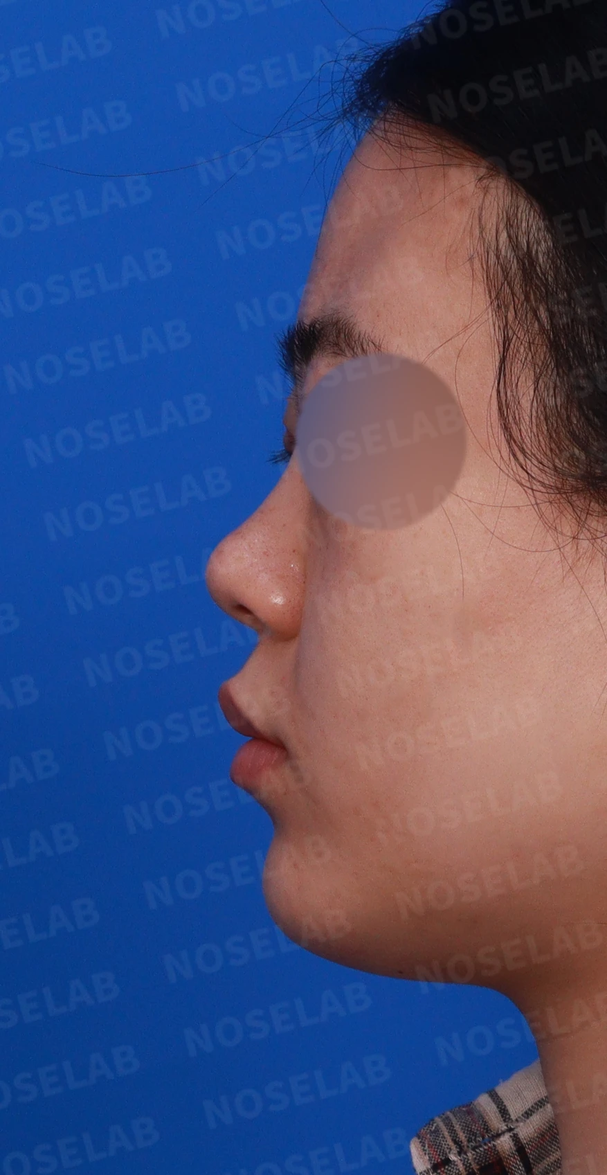 코끝 피부가 두껍고 잘 늘어나지 않는 코에서 높이와 직반 라인을 만드는 방법 — 디자인 상담 정면, 좌측 측면, 비스듬한 측면 사진