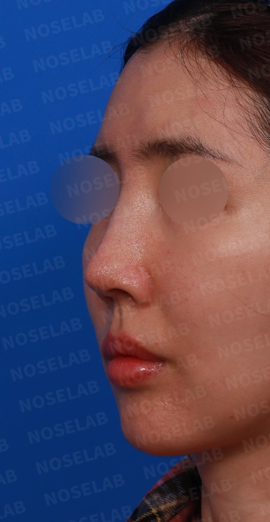 긴 코와 비대칭을 함께 교정하는 재수술 방법 — 디자인 상담 정면, 좌측 비스듬한 측면, 측면 사진
