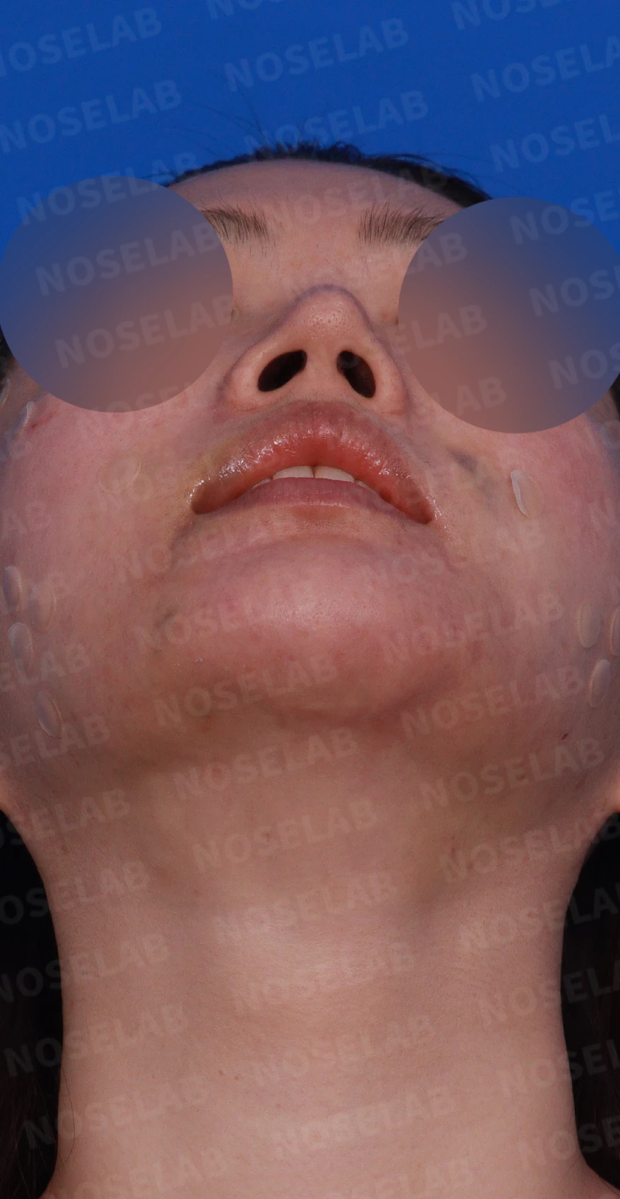재수술한 코가 휘어 보이고 코끝이 처지는 이유 — 디자인 상담 우측 비스듬한 측면, 측면, 비공 사진