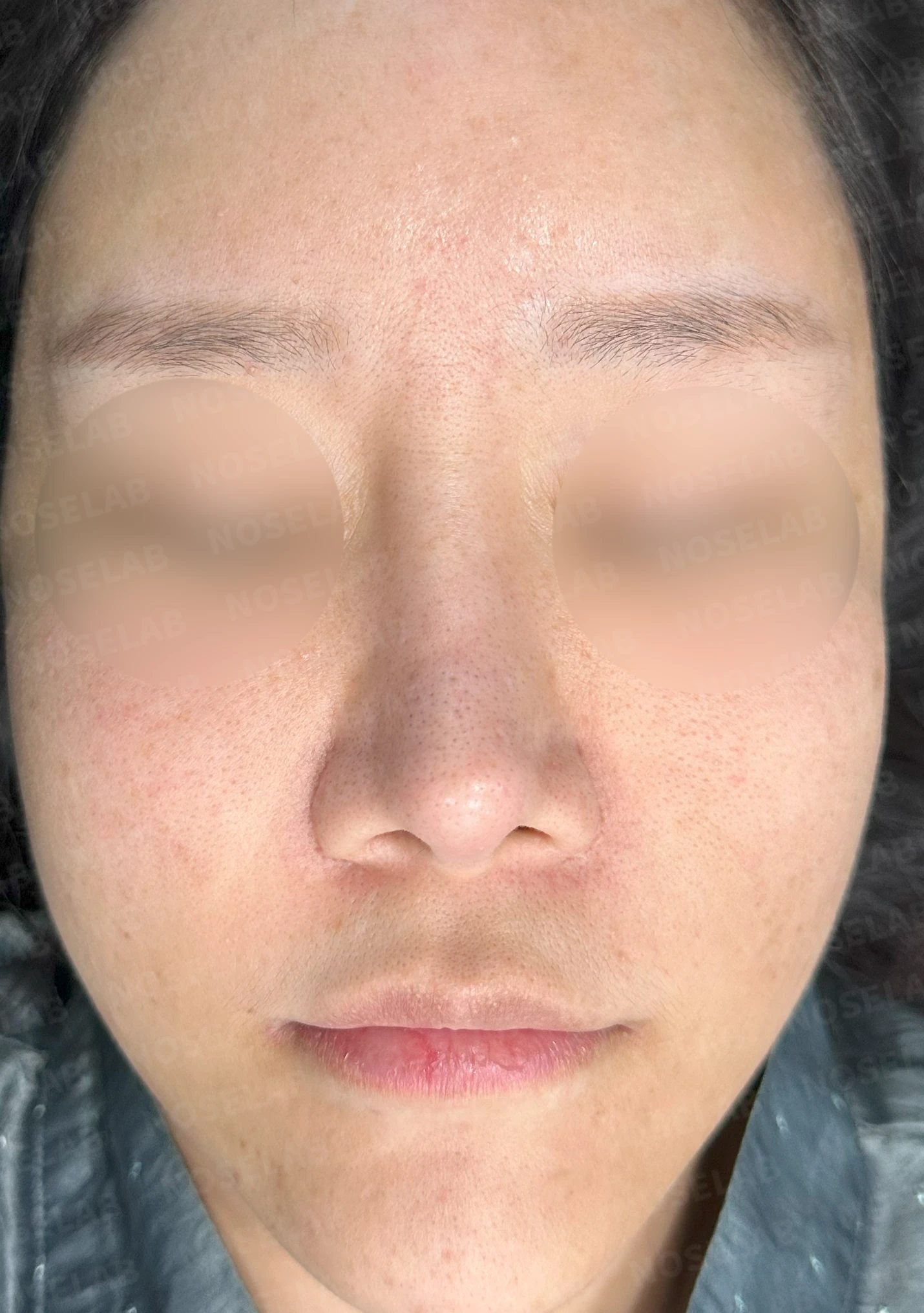 흡수된 기증늑연골을 자가늑연골로 교체 사례 — 전(좌) 직후(우)