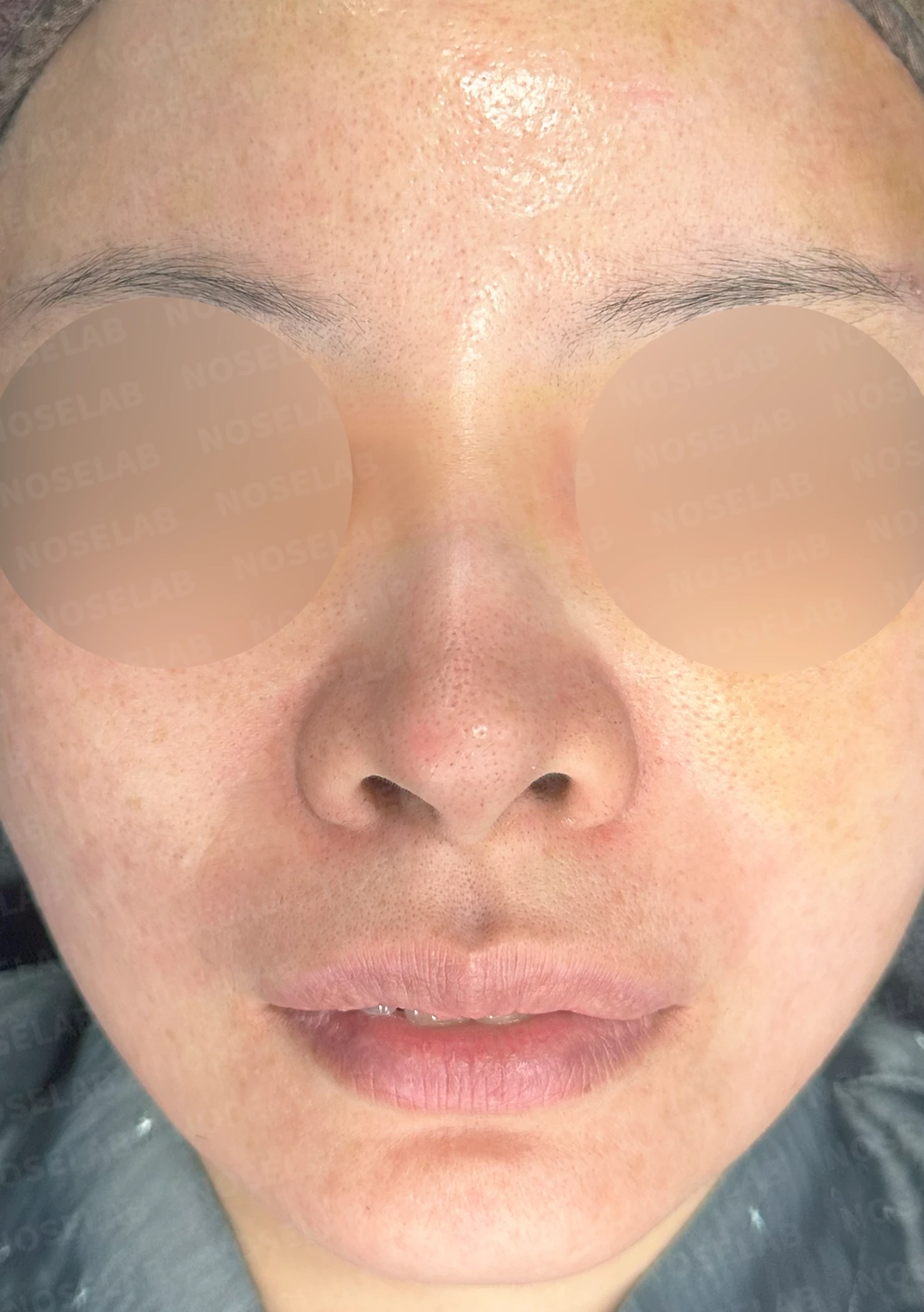 외상으로 코뼈가 부러지면 코가 어떻게 변형되고, 정복과 재건은 어떻게 하나 — 수술 전 / 수술 직후 0일 직후 사진은 부기가 있는 상태로 최종 결과와 다를 수 있습니다.