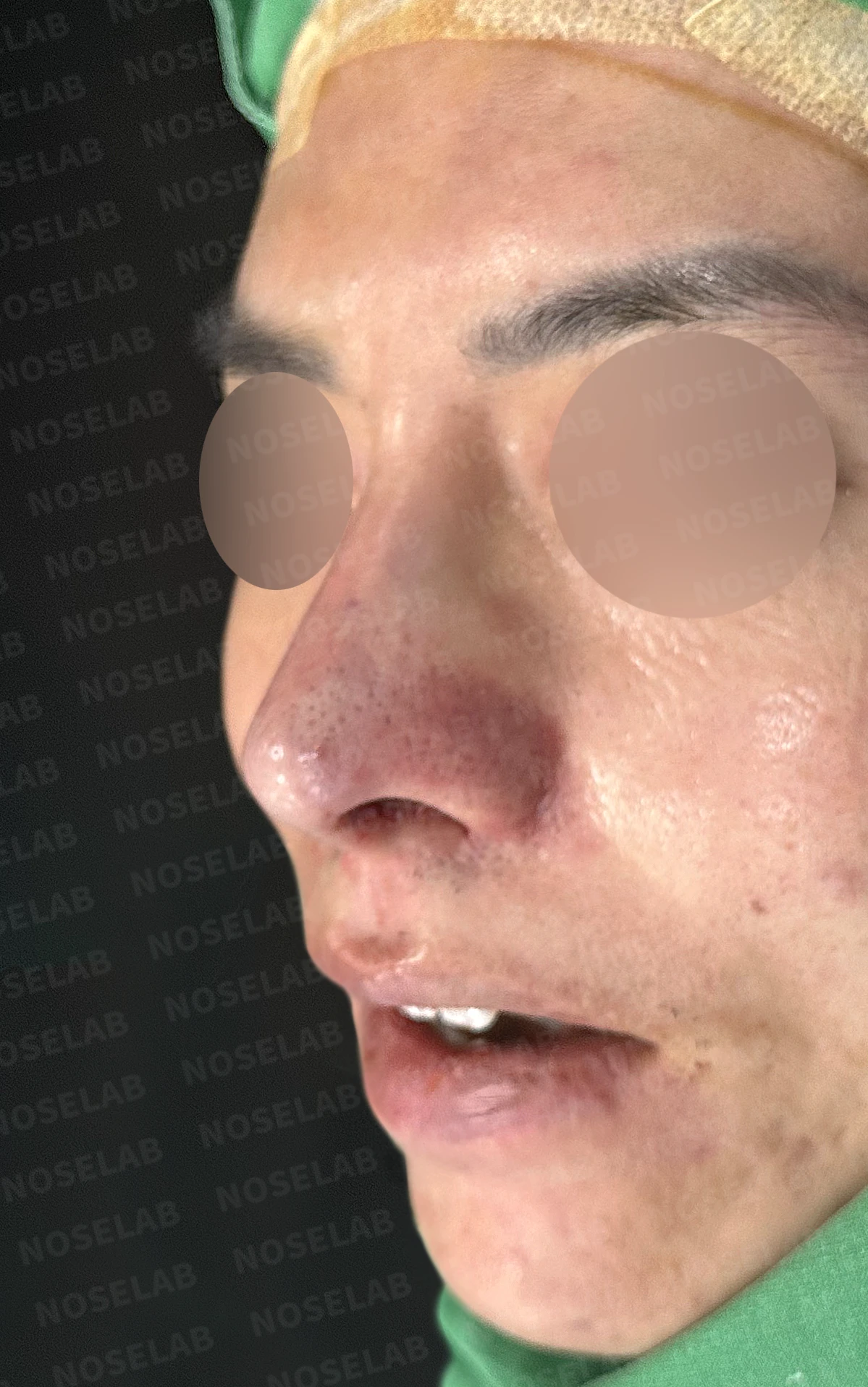 코재수술과 코막힘 교정, 기능과 심미 모두 잡은 비개방 코성형 사례 — 직후 정면, 비스듬한 측면, 측면 사진입니다.