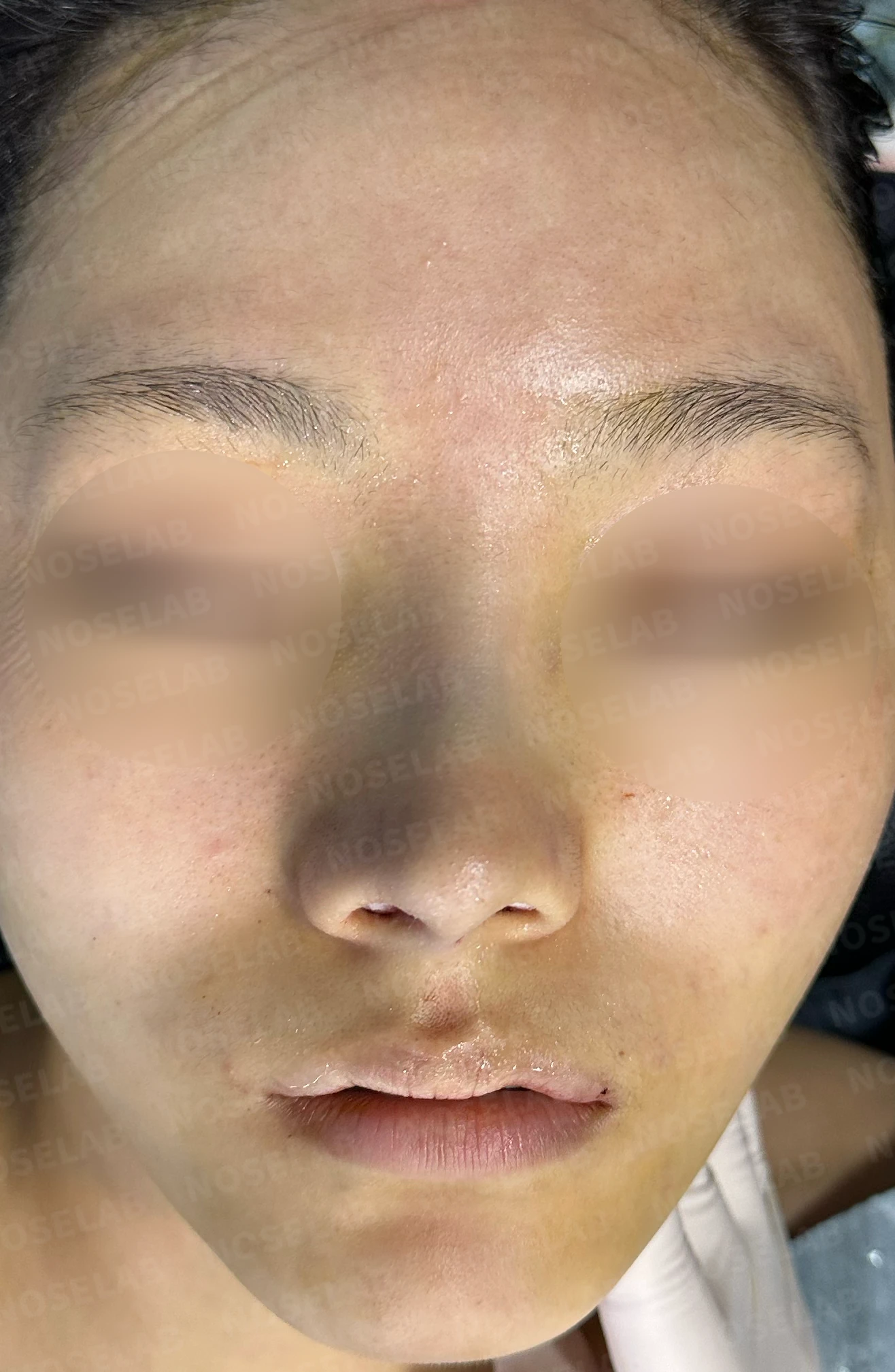 긴코·퍼진코 교정 방법 — 수술 전 / 수술 직후 0일 직후 사진은 부기가 있는 상태로 최종 결과와 다를 수 있습니다.
