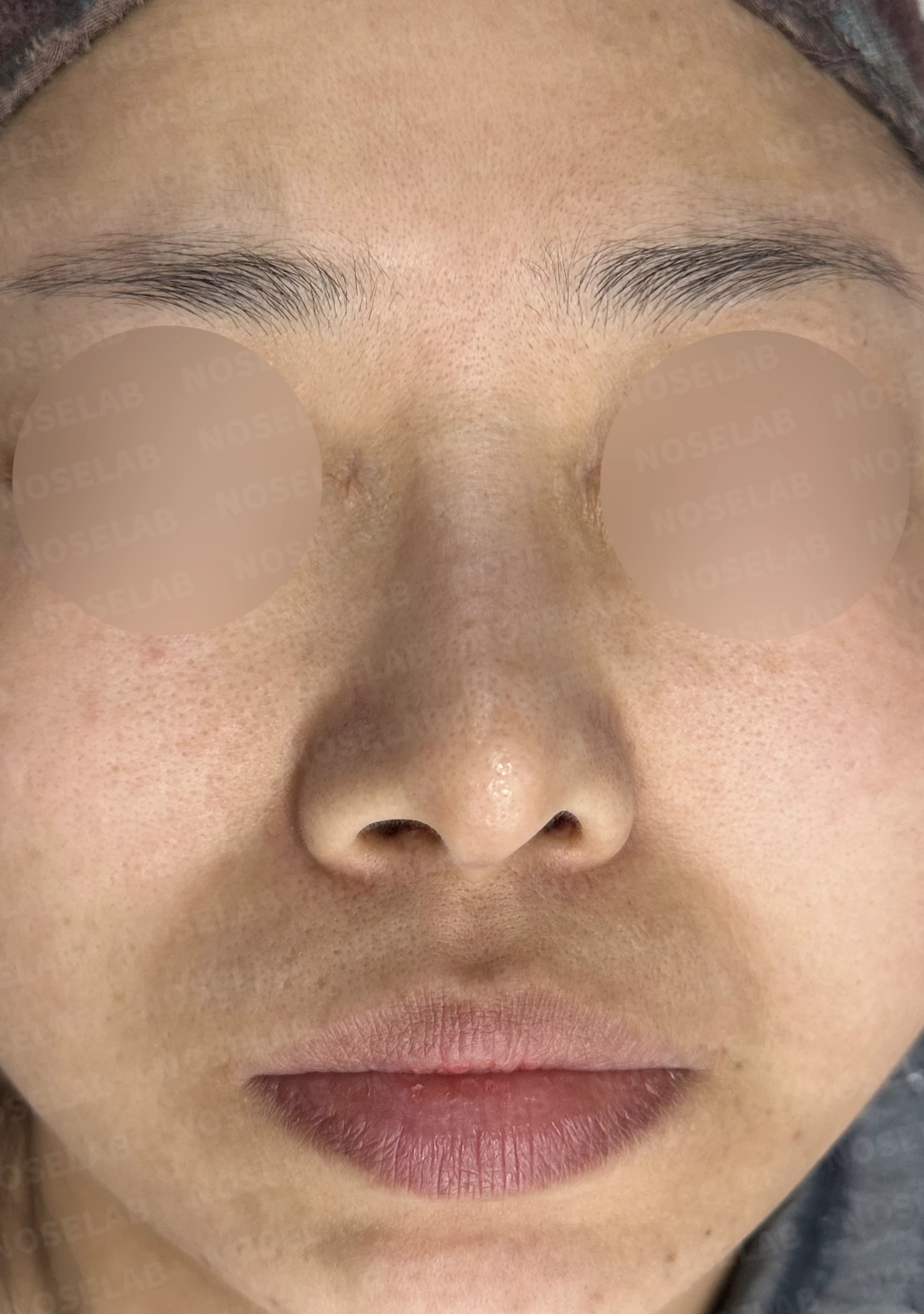 비공 비대칭과 휘어진 코, 자가늑연골 재건으로 교정한 코재수술 — 전(좌) 직후(후)