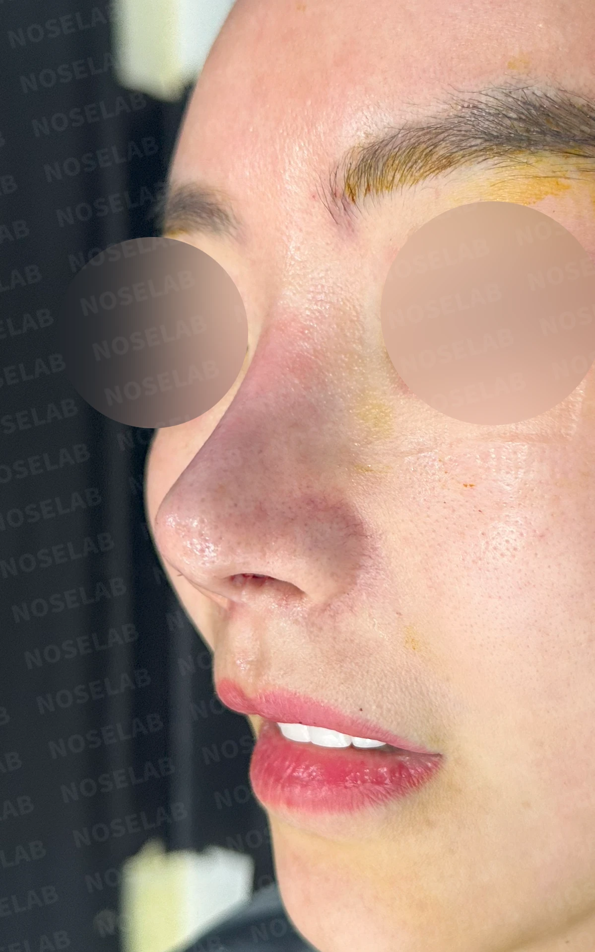 이식한 진피가 반복해서 흡수되는 이유, 재건은 어떻게 하나 — 수술 전 / 수술 직후 0일 직후 사진은 부기가 있는 상태로 최종 결과와 다를 수 있습니다.