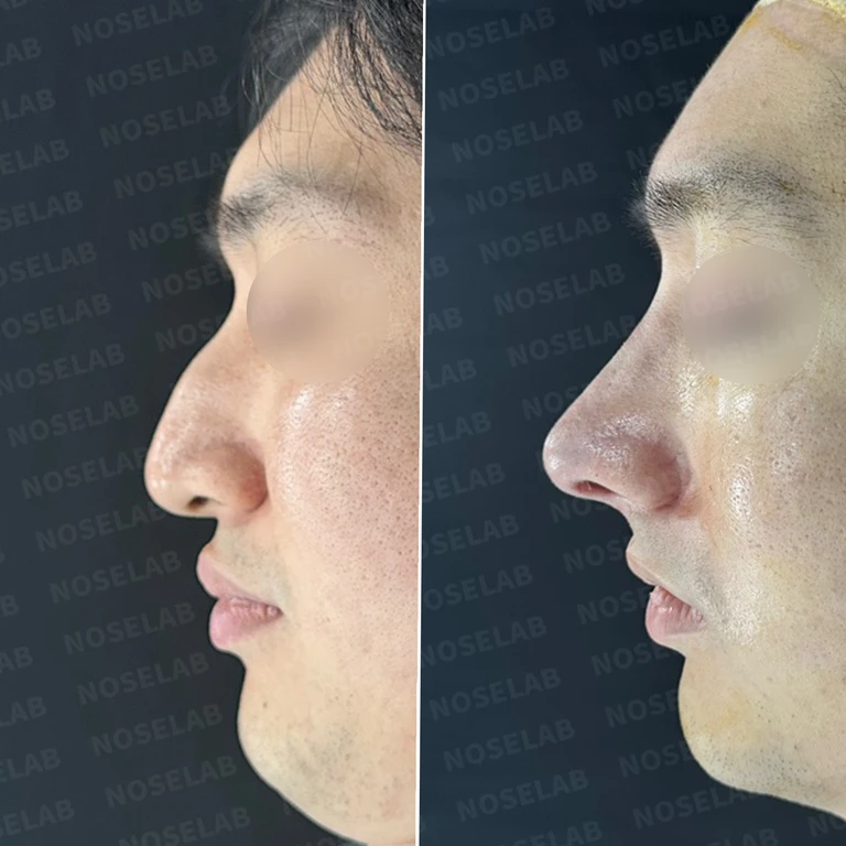 매부리코에 코막힘이 함께 오는 이유, 자가 늑연골만으로 하는 교정 방법 — 전후 비교