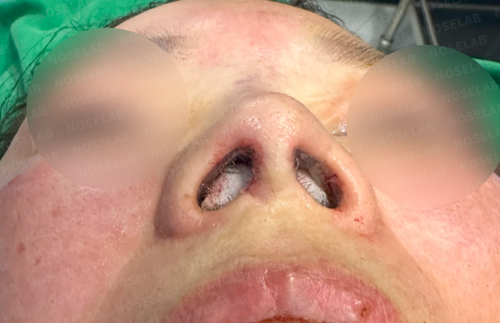 불법 주사 시술 뒤 코가 들리고 짧아지는 이유, 이물질 제거와 재건은 어떻게 하나 — 수술 전 / 수술 직후 0일 직후 사진은 부기가 있는 상태로 최종 결과와 다를 수 있습니다.