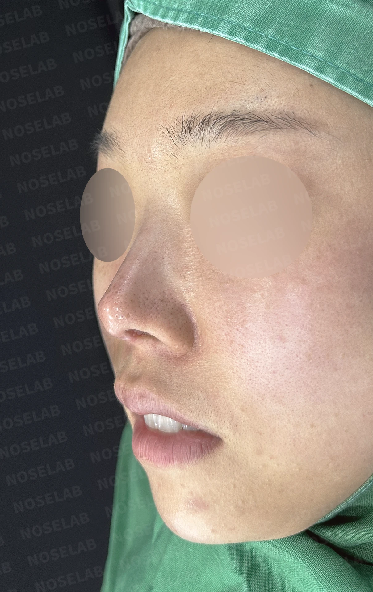 코끝 피부가 얇아져 연골이 비치는 이유, 피부 보강은 어떻게 하나 — 수술 전 / 수술 직후 0일 직후 사진은 부기가 있는 상태로 최종 결과와 다를 수 있습니다.