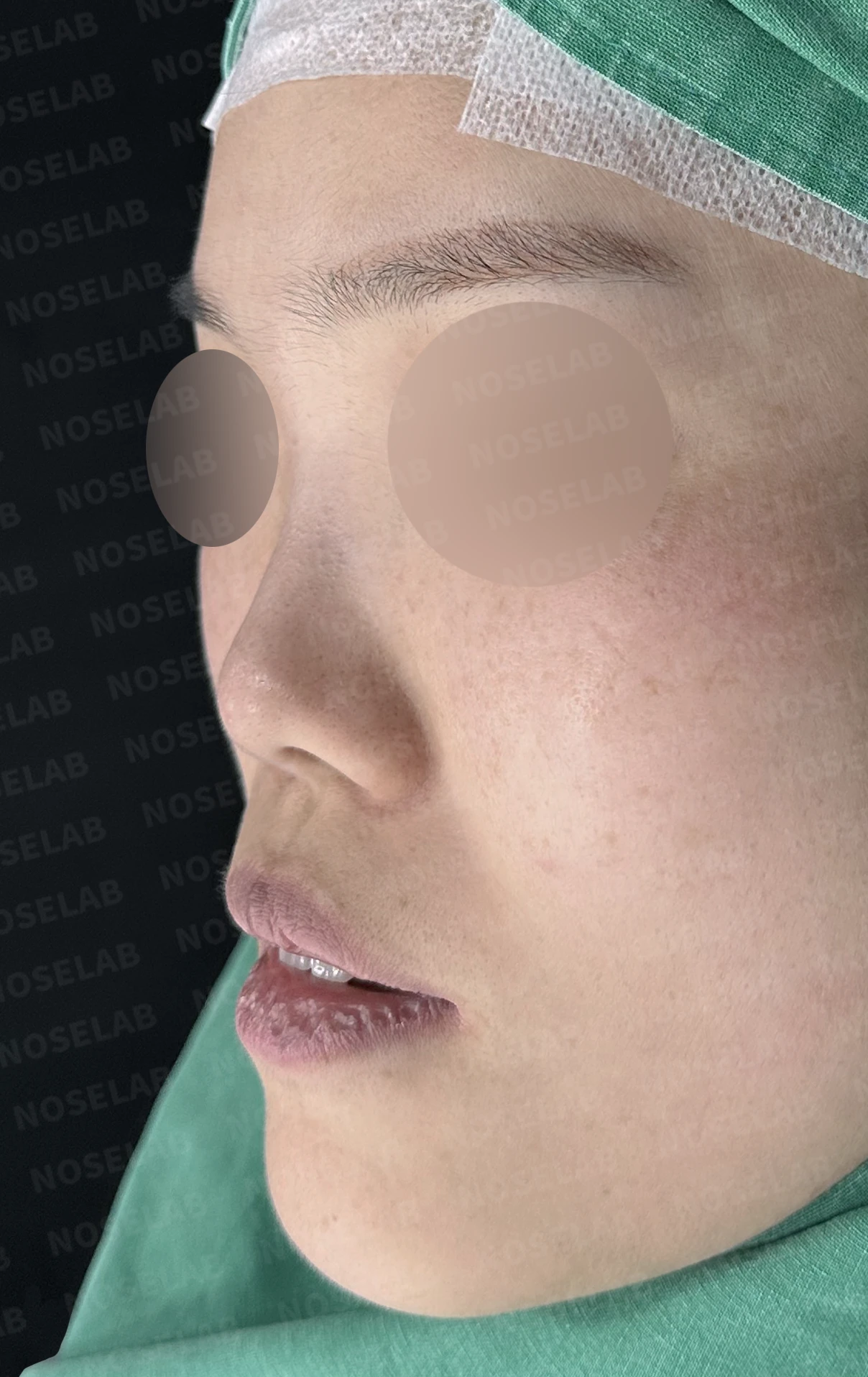 짧고 들린 코와 휜 코가 함께 생기는 이유, 비중격 연장 교정은 어떻게 하나 — 수술 전 / 수술 직후 0일 직후 사진은 부기가 있는 상태로 최종 결과와 다를 수 있습니다.