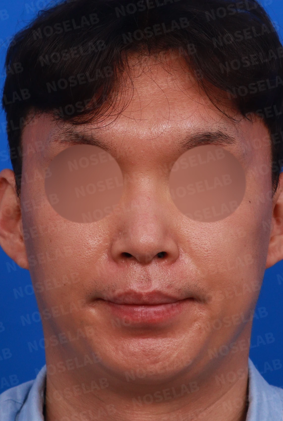 콧대 시작점과 얼굴 비율을 고려한 코성형 방법 — 수술전 정면, 좌측 측면, 비스듬한 측면 사진입니다.