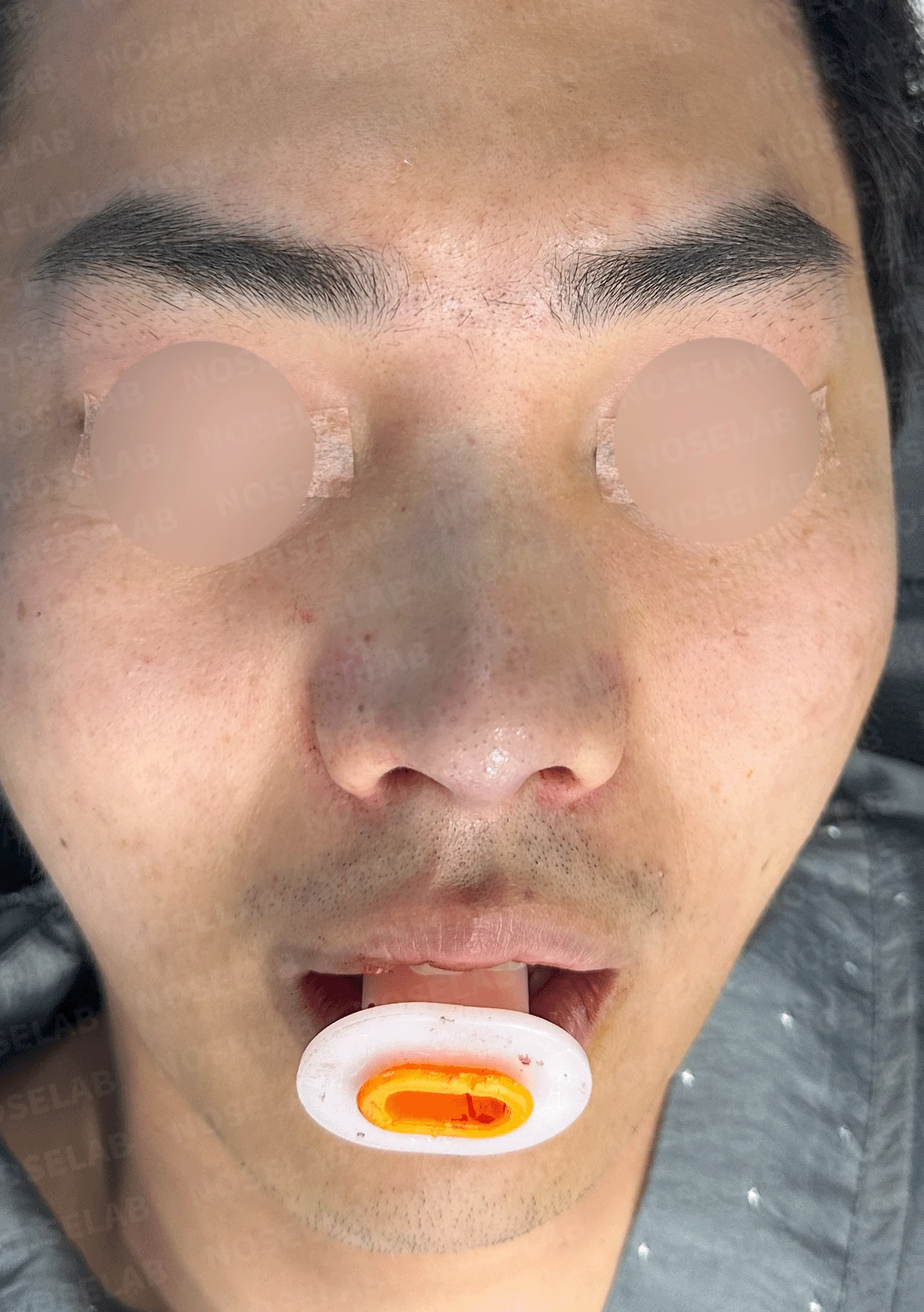 휜 코와 비공 노출 개선 - 자연스러운 코끝 상승 사례 — 직후 정면, 측면, 비스듬한 측면 사진