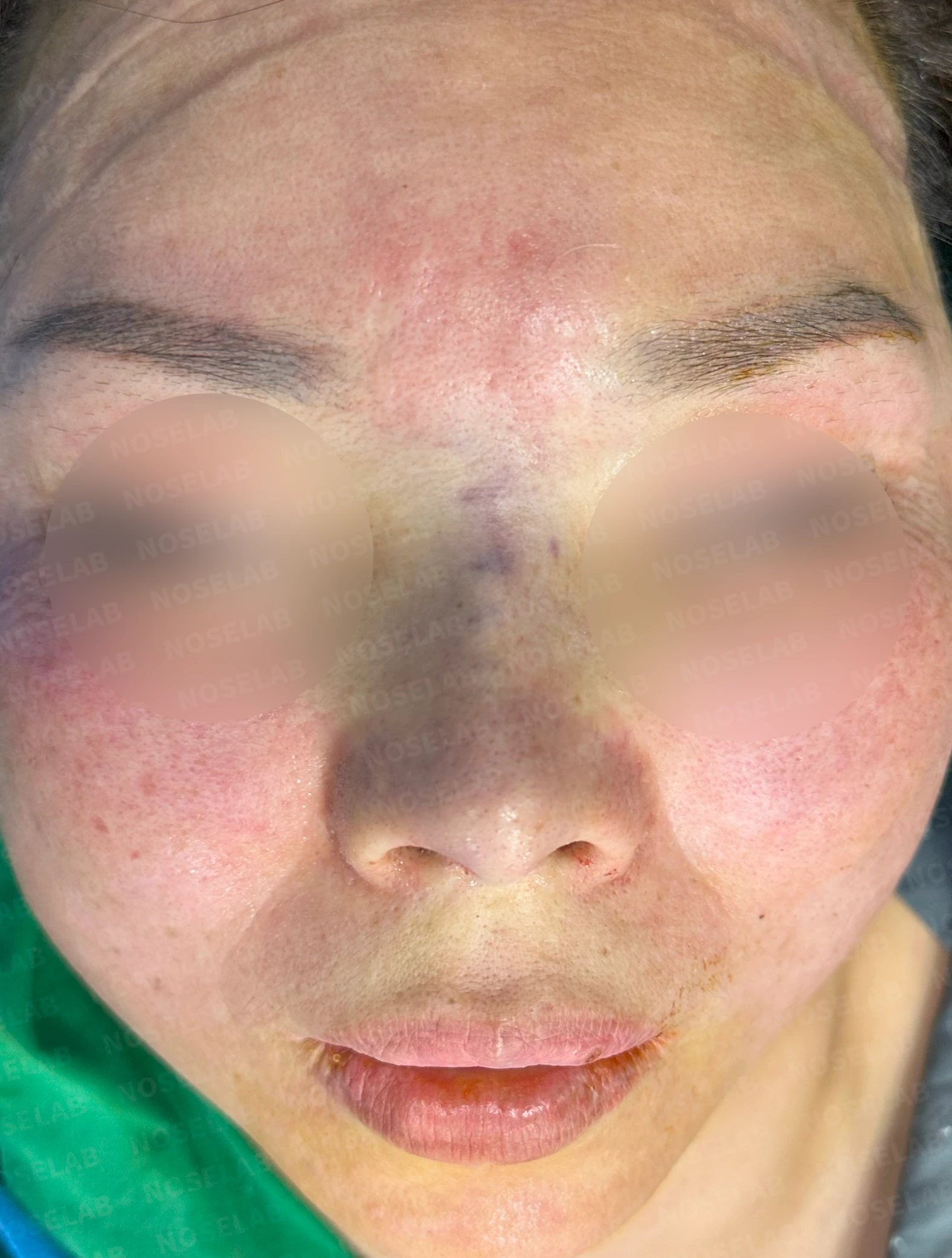 불법 주사 시술 뒤 코가 들리고 짧아지는 이유, 이물질 제거와 재건은 어떻게 하나 — 수술 전 / 수술 직후 0일 직후 사진은 부기가 있는 상태로 최종 결과와 다를 수 있습니다.