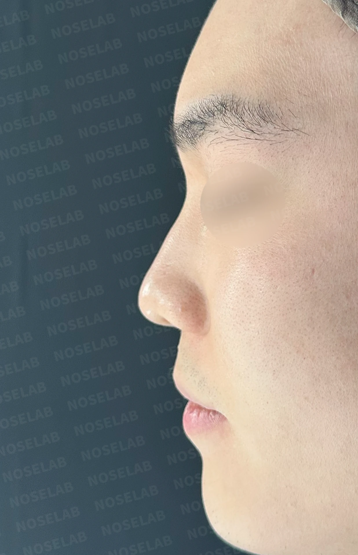 코 실 시술과 지방이식 후 라인이 잡히지 않는 이유, 제거와 늑연골 재건은 어떻게 하나 — 수술 전 / 수술 직후 0일 직후 사진은 부기가 있는 상태로 최종 결과와 다를 수 있습니다.