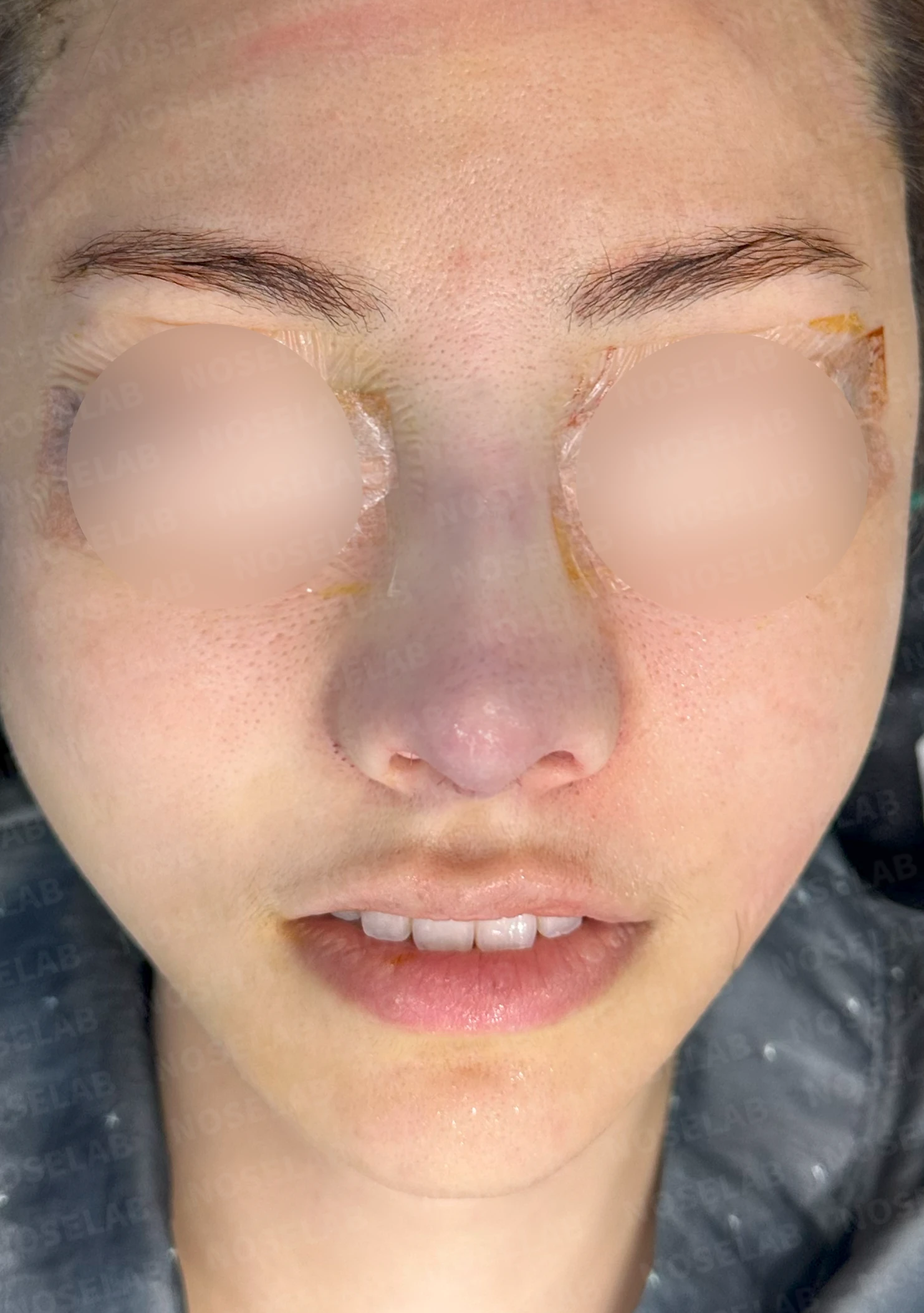 필러와 실 시술을 반복한 코에 미간이 퍼지고 코끝이 들리는 이유 — 수술 직후 0일 정면 , 비스듬한 측면 , 측면 사진 입니다. 직후 사진은 부기가 있는 상태로 최종 결과와 다를 수 있습니다.