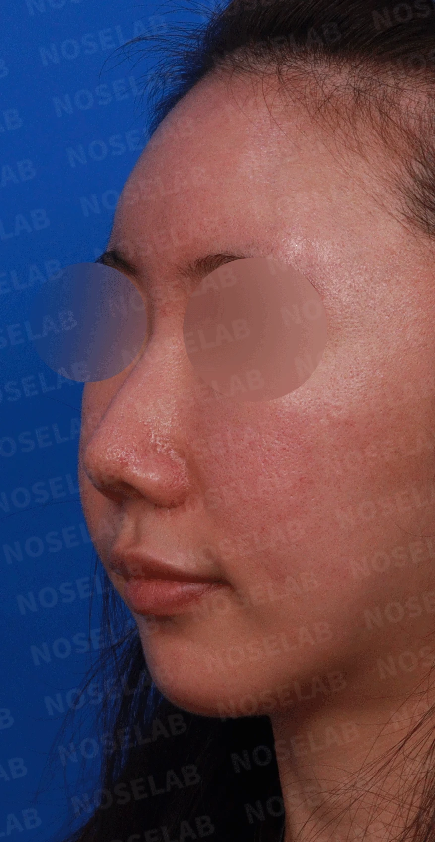 오래된 코 수술 뒤 비주가 함몰되고 코끝이 뭉툭해지는 이유와 재건 방법 — 디자인 상담 정면, 좌측 비스듬한 측면, 측면 사진
