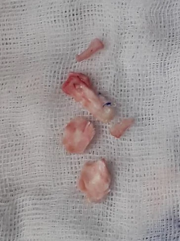 코끝 고어텍스가 문제를 일으키는 이유와 늑연골 비중격 재건 방법 — 본문 사진 7