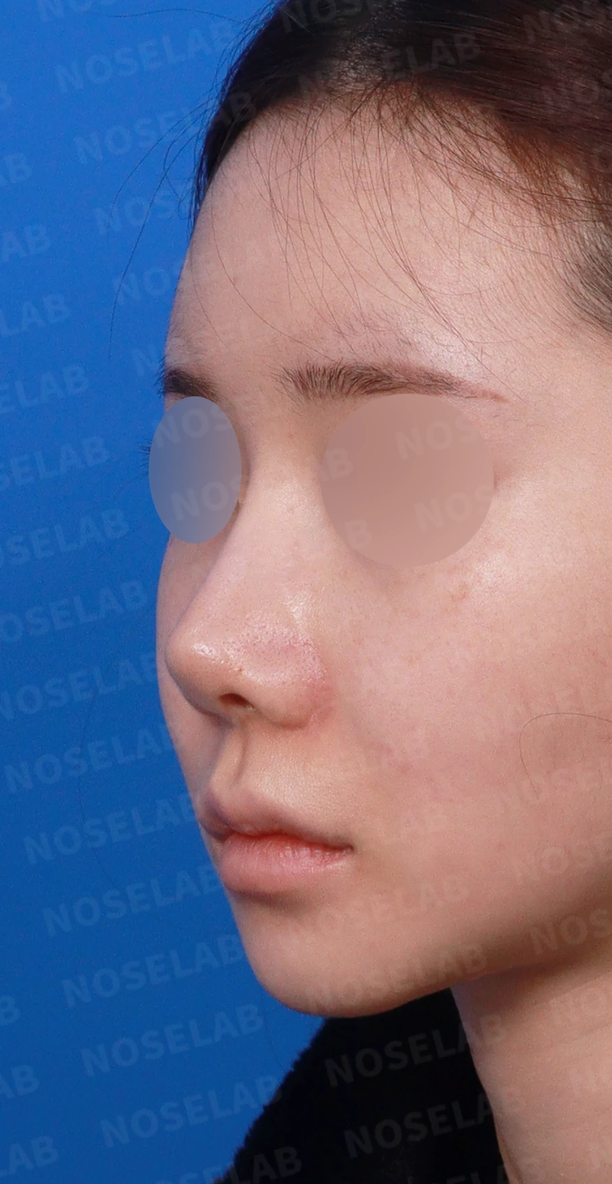 코성형 뒤 코끝이 들리고 비주가 짧아 보이는 이유, 비주 하강과 콧대 라인 교정 방법 — 디자인 상담 정면, 좌측 측면, 비스듬한 측면 사진입니다.