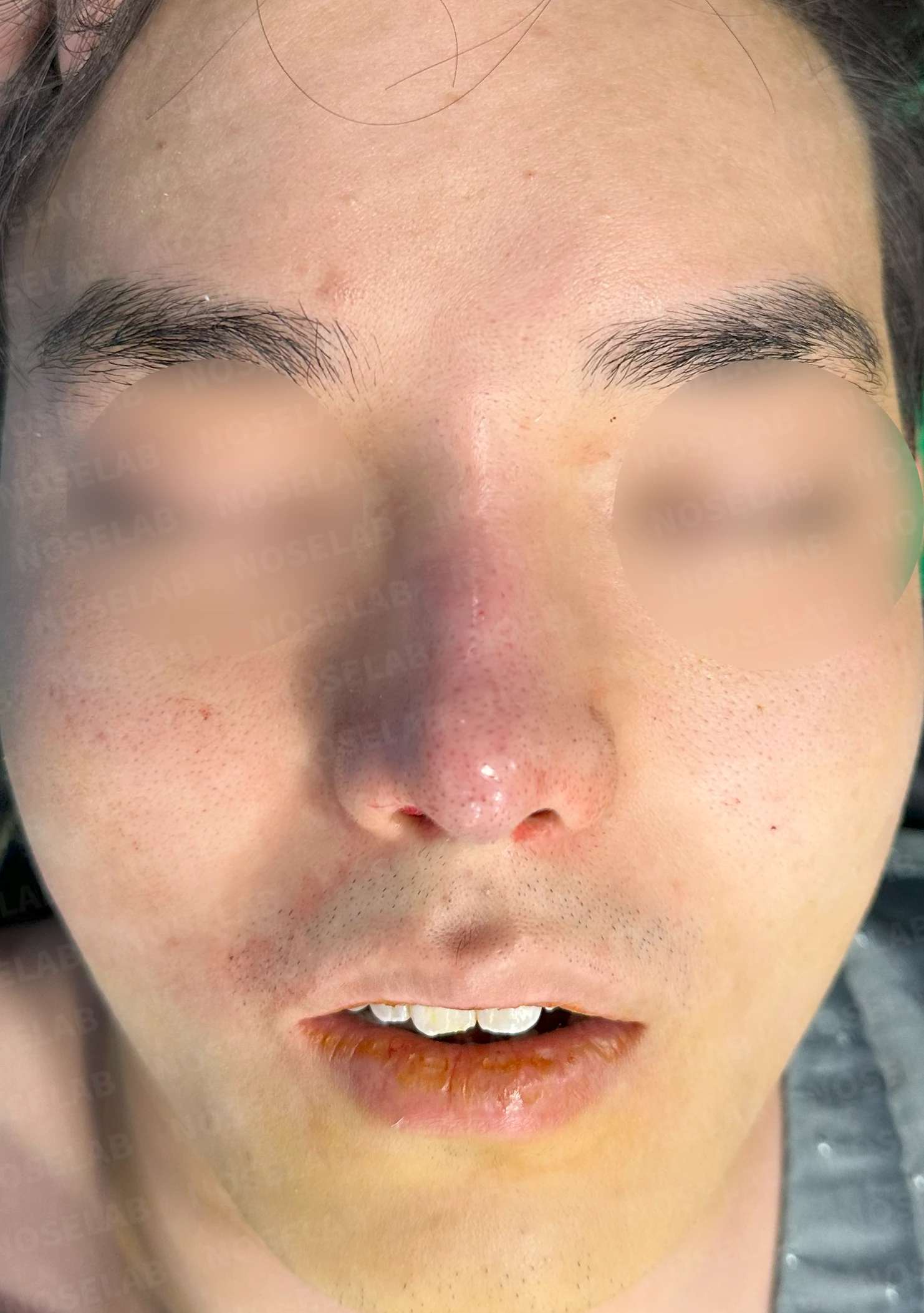코 실 시술과 지방이식 후 라인이 잡히지 않는 이유, 제거와 늑연골 재건은 어떻게 하나 — 수술 직후 0일 정면, 비스듬한 측면, 측면 사진입니다. 직후 사진은 부기가 있는 상태로 최종 결과와 다를 수 있습니다.