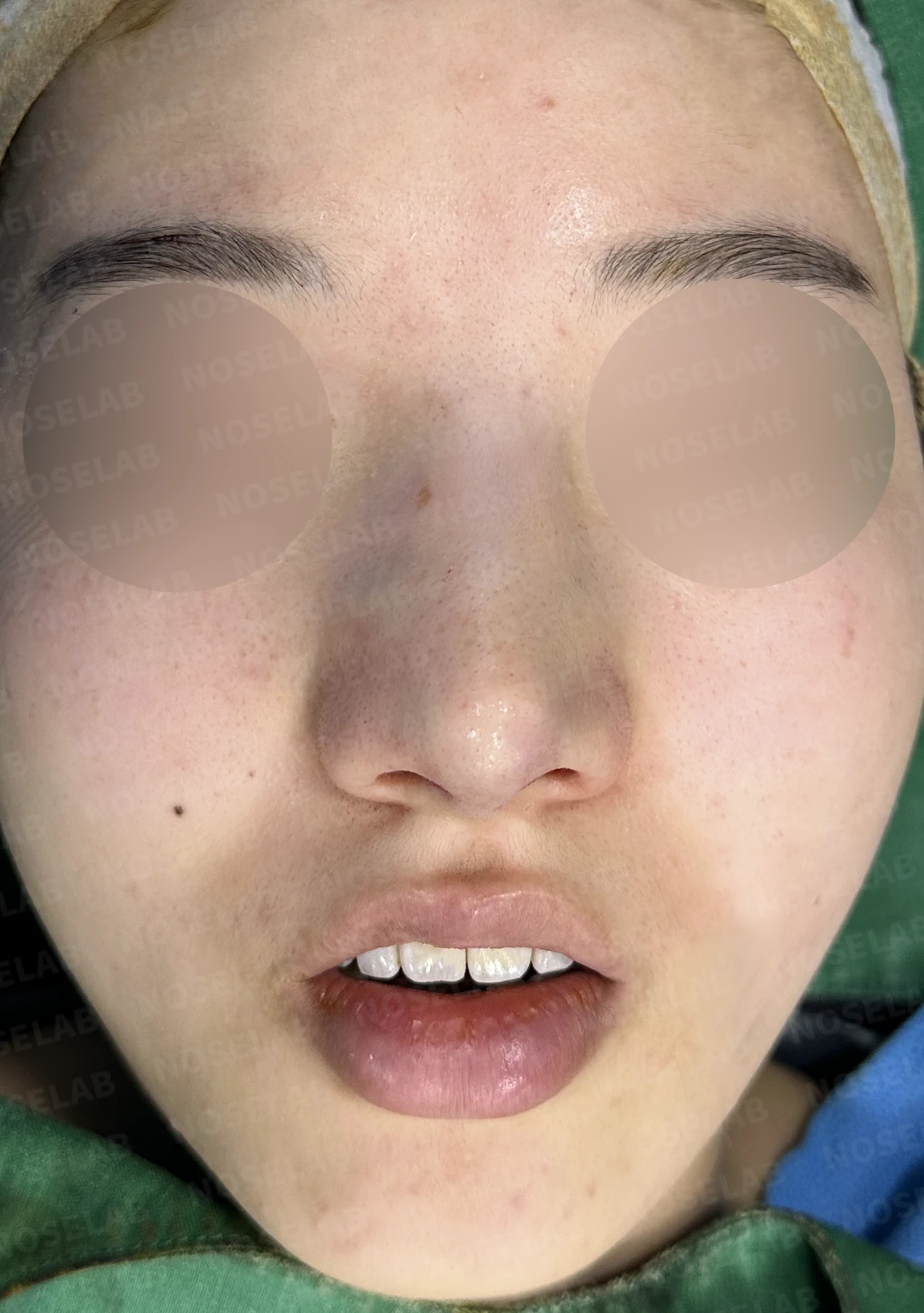 매부리코와 긴코 교정, 자가늑연골로 오똑한 코끝과 코막힘까지 해결 — 수술직후 정면, 비스듬한 측면, 측면 사진입니다.