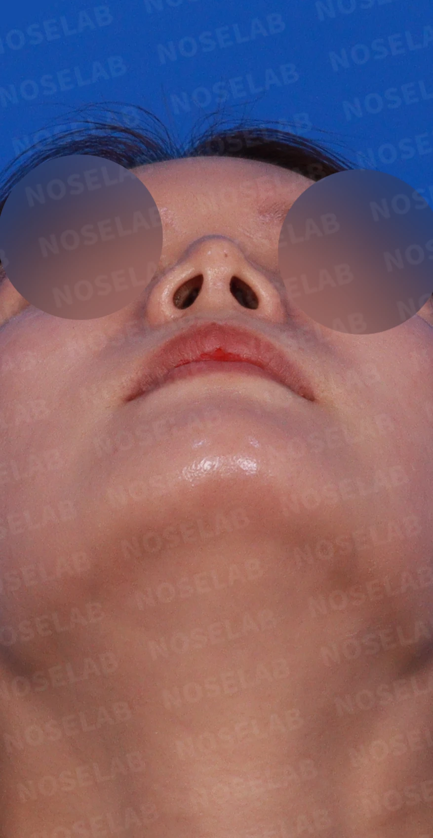 기증 늑연골이 흡수되면 코가 어떻게 변하고, 자가 늑연골 재건은 어떻게 하나 — 디자인 상담 우측 측면 , 비스듬한 측면, 비공 사진