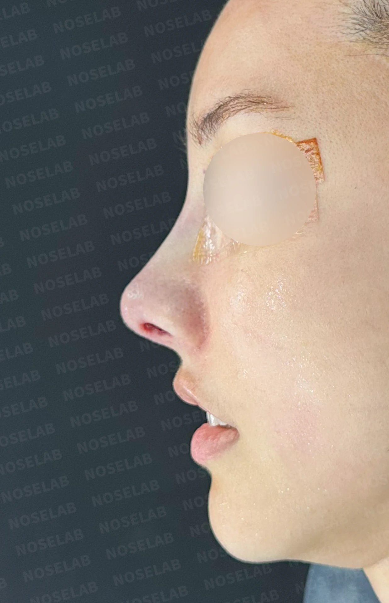 필러와 실 시술을 반복한 코에 미간이 퍼지고 코끝이 들리는 이유 — 수술 전 / 수술 직후 0일 직후 사진은 부기가 있는 상태로 최종 결과와 다를 수 있습니다.