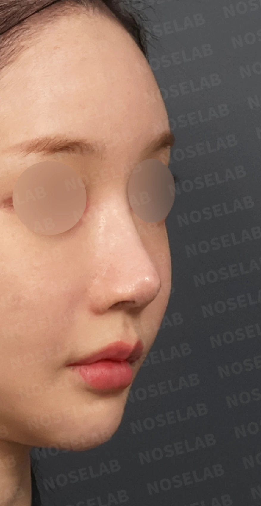 여러 차례 코수술 후 자가늑연골과 자가진피로 코 전체를 자연스럽게 높인 재수술 — 디자인 상담 우측 측면, 비스듬한 측면, 비공 사진입니다.