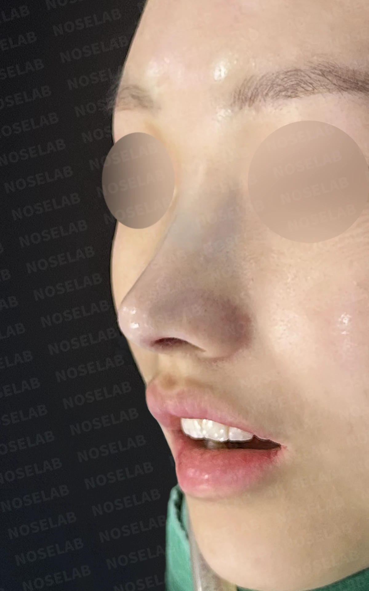 무보형물 코성형, 휘어진 콧대와 처진 코끝을 자연스럽게 교정 — 직후 정면, 비스듬한 측면, 측면 사진입니다.