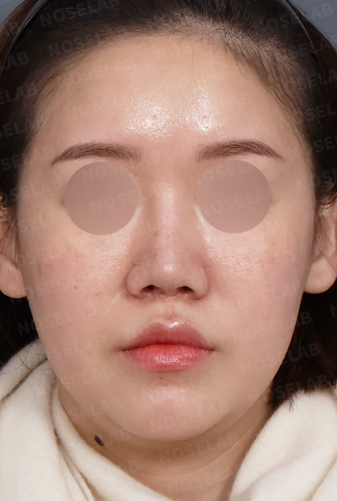 비주 함몰과 콧날개 변형, 자가늑연골을 이용한 코재수술로 자연스럽게 교정 — 디자인 상담 정면, 좌측 측면, 비스듬한 측면 사진입니다.