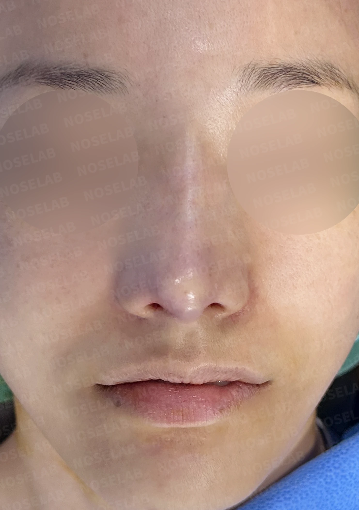 콧대 인공진피가 매부리로 남는 이유와 제거 후 재건 방법 — 수술 직후 0일 정면, 비스듬한 측면, 측면 사진입니다. 직후 사진은 부기가 있는 상태로 최종 결과와 다를 수 있습니다.