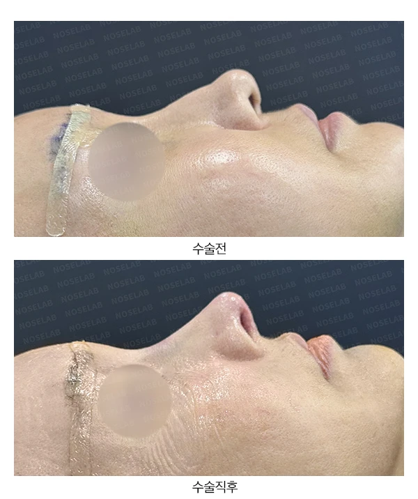 코의 높이와 입체감을 고려한 수술 계획 — 전후 비교