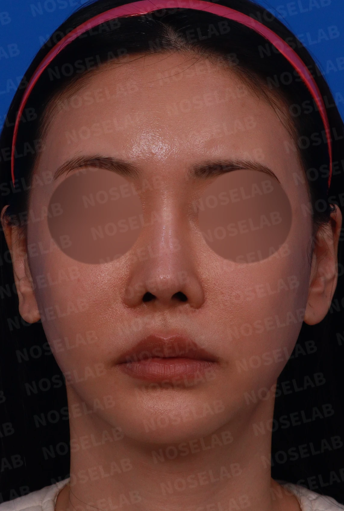 들린코와 시작점 내리고 화려하게 수술사례 — 디자인 상담 정면, 좌측 측면, 비스듬한 측면 사진