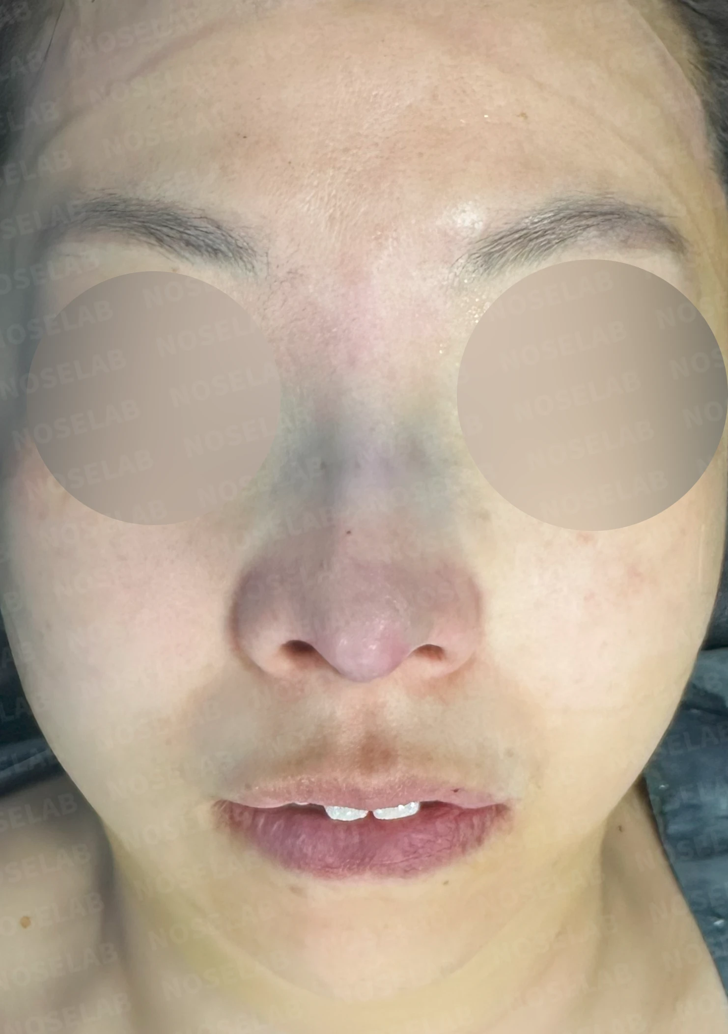 들창코에서 콧구멍이 많이 보이는 이유, 코끝 위치 교정은 어떻게 하나 — 수술 직후 0일 정면, 측면, 비스듬한 측면 사진 직후 사진은 부기가 있는 상태로 최종 결과와 다를 수 있습니다.