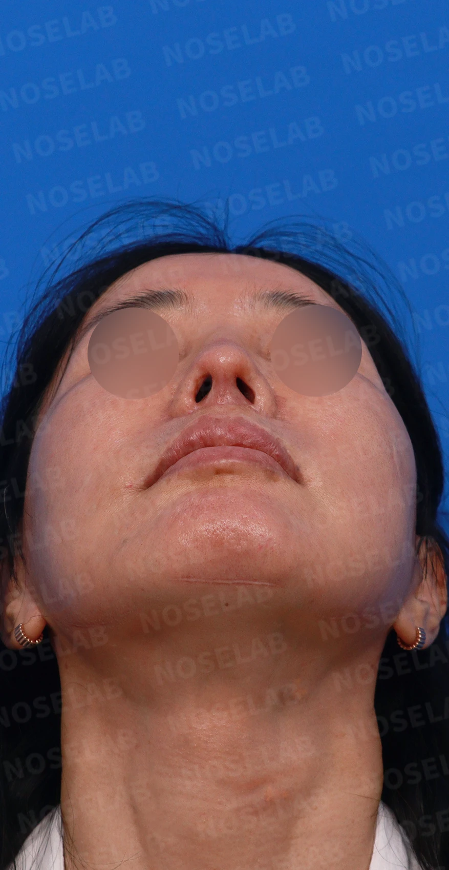 여러 차례 수술 뒤 비중격이 손상되면, 늑연골 재건은 어떻게 하나 — 디자인 상담 우측 측면, 비스듬한 측면, 비공 사진입니다.