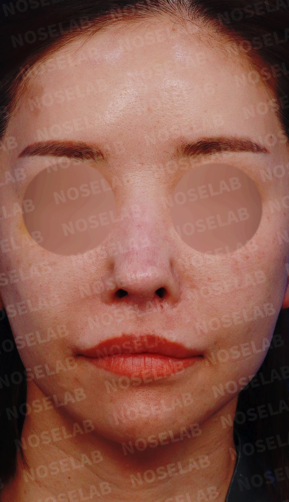 두꺼운 비주와 들린 코끝이 생기는 이유, 자가 늑연골 재건은 어떻게 하나 — 디자인 상담 정면, 좌측 측면, 비스듬한 측면 사진입니다.