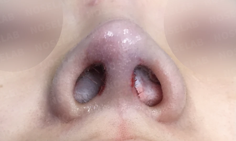 짧은 코의 비개방 교정 방법과 얼굴 비율 — 수술 직후 0일 콧구멍 사진입니다. 직후 사진은 부기가 있는 상태로 최종 결과와 다를 수 있습니다.