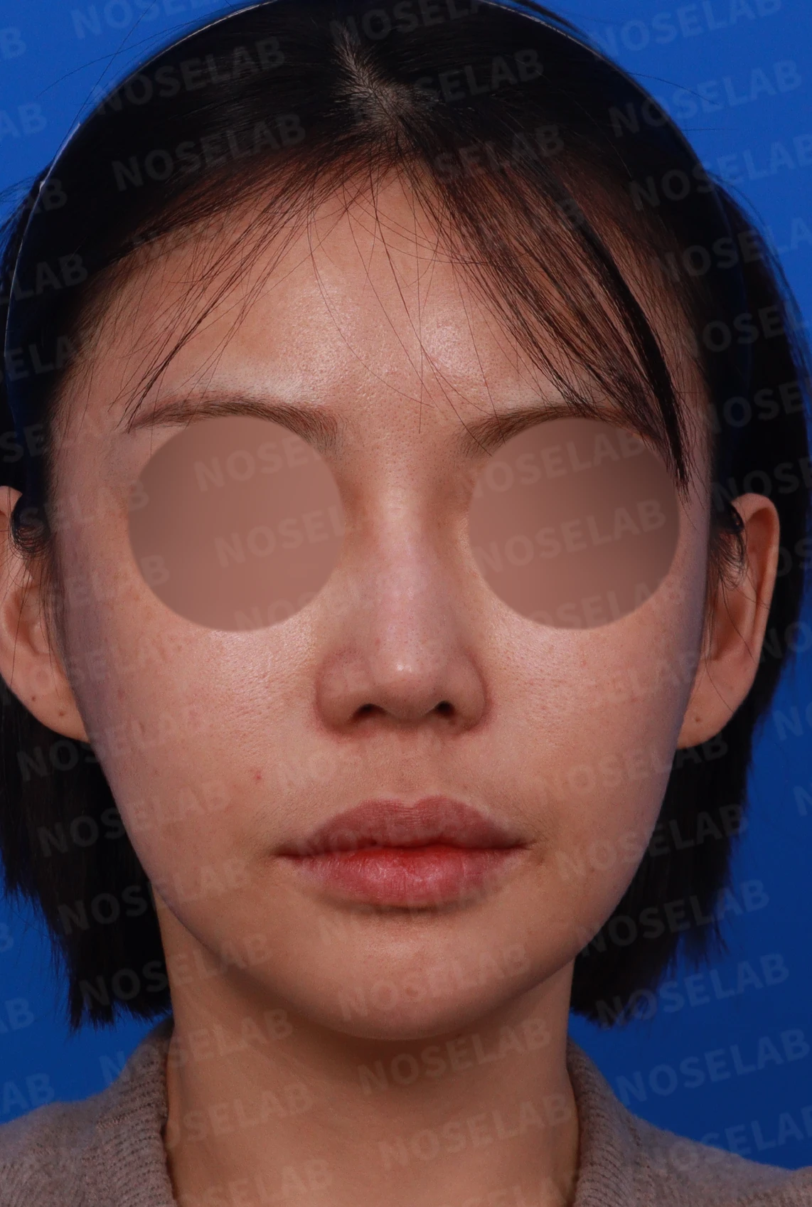 고양이 보형물 제거와 자연스러운 코 재건 - 휘어진 코성형 후기 — 디자인 상담 정면, 좌측 측면, 비스듬한 측면 사진