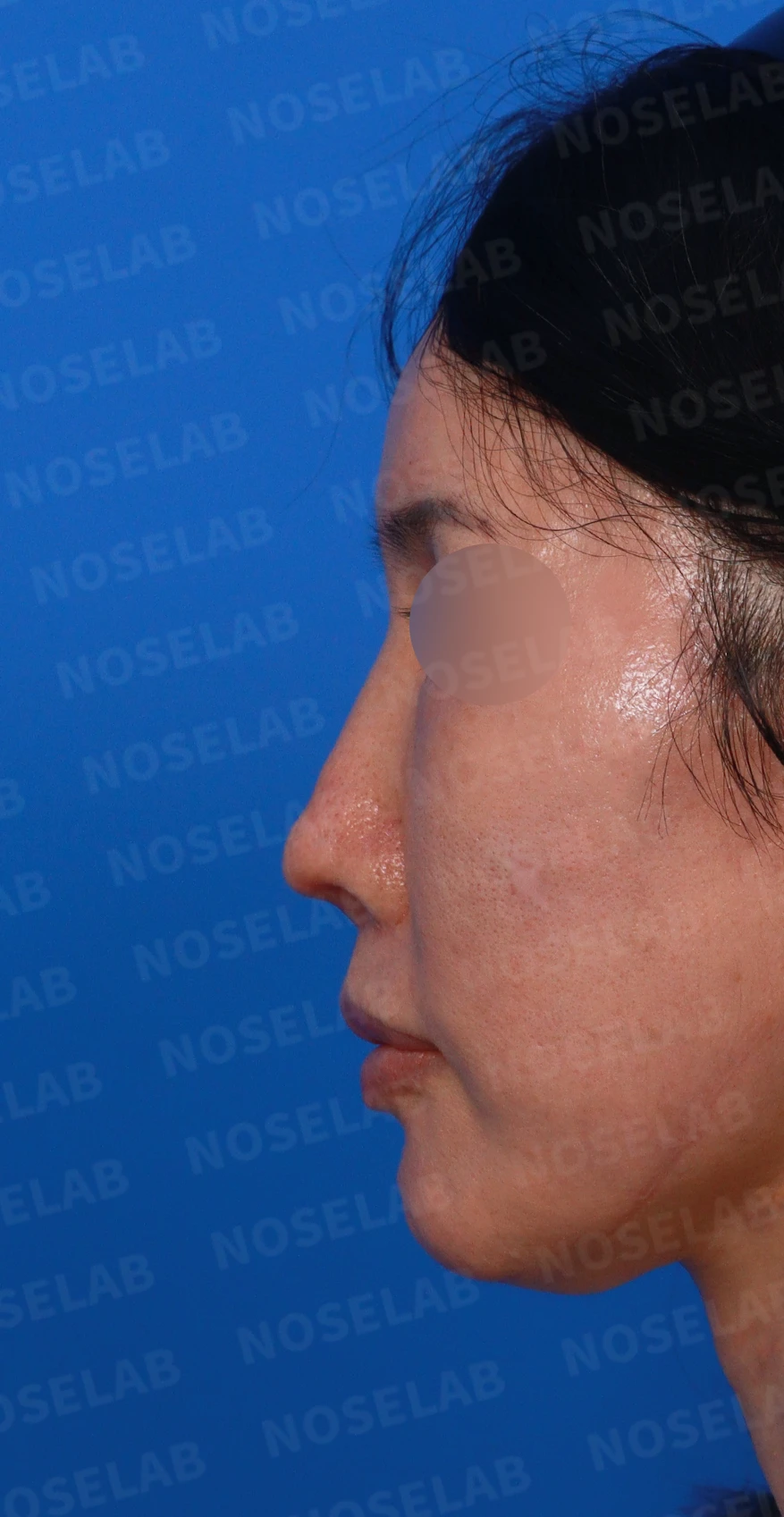 여러 차례 수술 뒤 비중격이 손상되면, 늑연골 재건은 어떻게 하나 — 디자인 상담 정면, 좌측 측면, 비스듬한 측면 사진입니다.