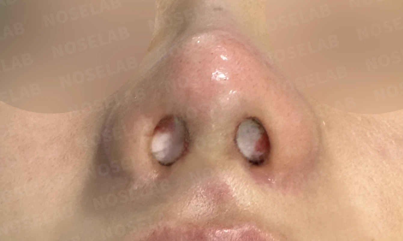 여러 차례 수술 뒤에도 코막힘과 휜 코가 남는 이유 — 수술 직후 0일 비공 사진입니다. 직후 사진은 부기가 있는 상태로 최종 결과와 다를 수 있습니다.