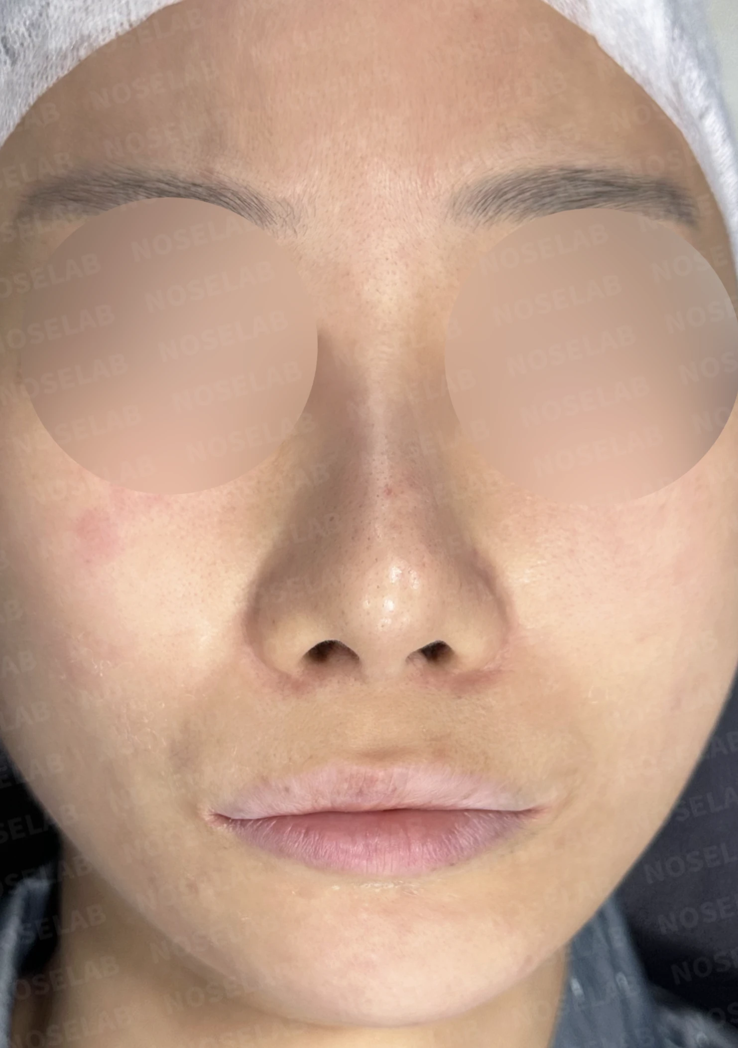비중격 천공이 생기면 무엇이 문제이고 어떻게 재건하나 — 수술 전 / 수술 직후 0일 직후 사진은 부기가 있는 상태로 최종 결과와 다를 수 있습니다.