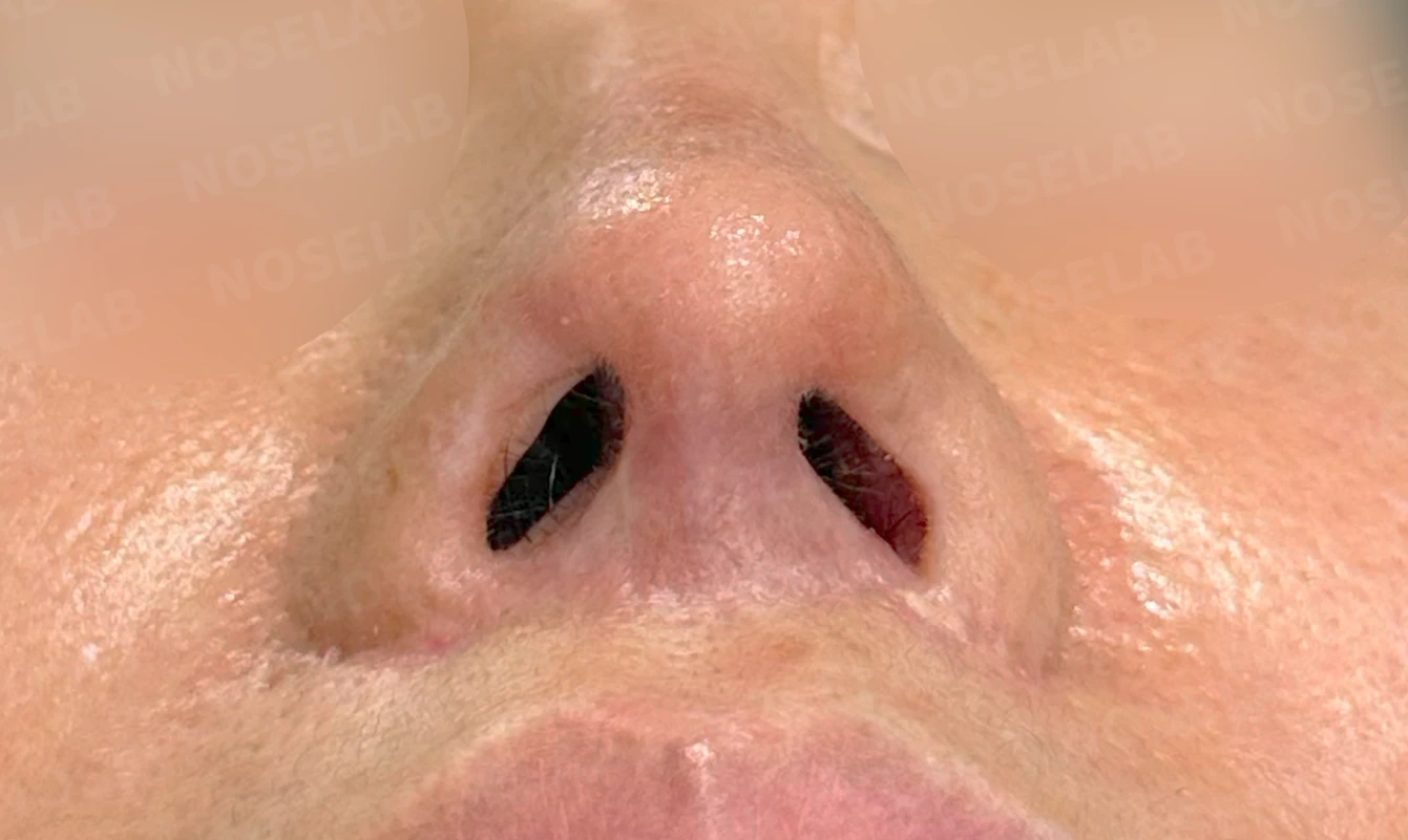 여러 차례 수술 뒤 비중격이 손상되면, 늑연골 재건은 어떻게 하나 — 수술 전 / 수술 직후 0일 직후 사진은 부기가 있는 상태로 최종 결과와 다를 수 있습니다.